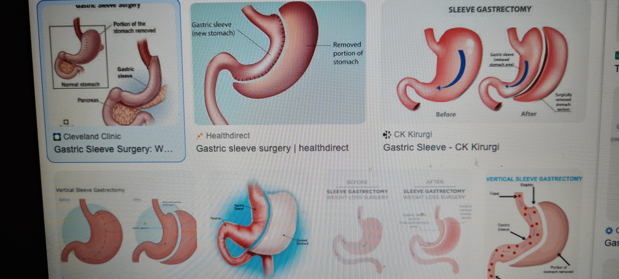 Hur går en gastric sleeve operation till och hur börjar man äta efter detta ingrepp?